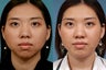 Chin Augmentation