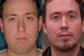 Chin Augmentation