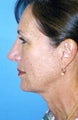 Chin Implant