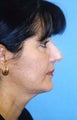 Chin Implant