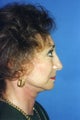 Chin Implant