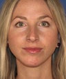 Chin Implant