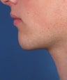 Chin Implant