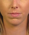 Chin Implant