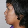 Chin Implant