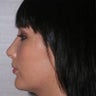 Chin Implant and Neck Liposuction