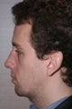 Chin Implant