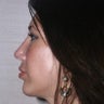 Chin Implant