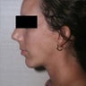Chin Implant
