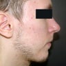 Chin Implant