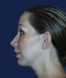 chin implant
