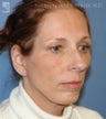 Chin Implant