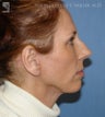 Chin Implant