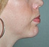 Chin Osteotomy