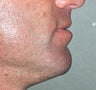 Chin Augmentation