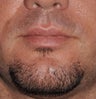 Chin Augmentation