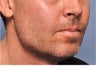 Jawline Augmentation