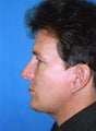 Chin Implant Procedure