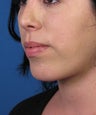 Chin Implant