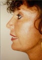 Chin Augmentation
