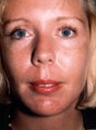 Chin Augmentation