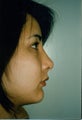 Chin Augmentation