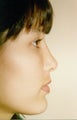 Chin augmentation