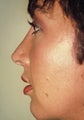 Chin Augmentation