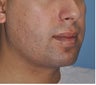 Chin and Jaw Angle Implants