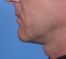 Chin Augmentation