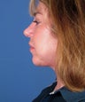 Chin Implant
