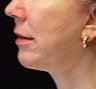 Chin Augmentation