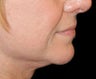 Chin Augmentation