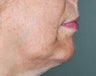 Chin Augmentation