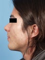 Chin Implant