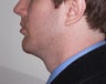 Chin Implant with neck liposuction