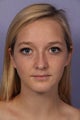 Chin Augmentation and Liposuction of Neck