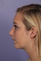Chin Augmentation and Liposuction of the Neck
