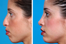 Rhinoplasty and Chin Implant