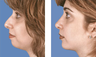 Rhinoplasty with chin implant front view