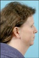 Chin Implant