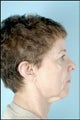 Chin Implant