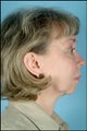 Chin Implant