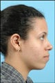 Rhinoplasty / Chin Implant