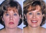 Liposuction of neck and chin augmentation