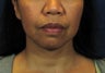 Chin Implant with Laser Facelift