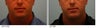 Chin Implant and Neck Liposuction