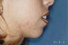 Chin Implants