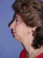 Chin Implants
