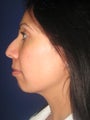 Chin Augmentation (Chin Implant)